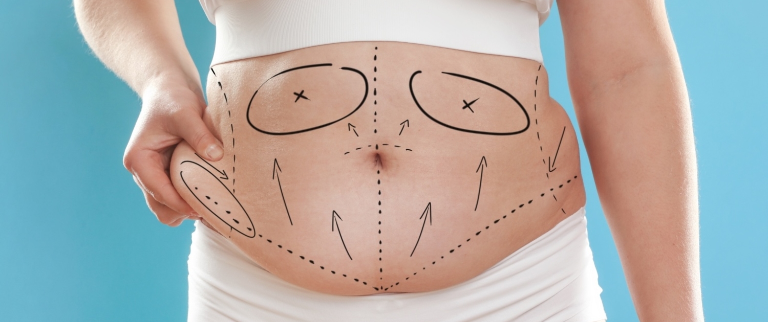 addominoplastica donna schema pre operatorio - chirurgia plastica