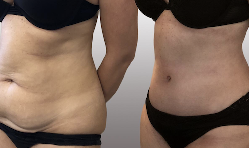 body lift prima e dopo l'intervento