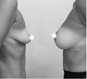 misure protesi seno mastoplastica additiva