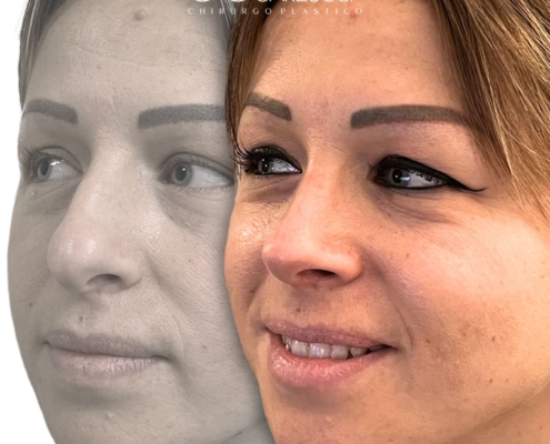 rinoplastica donna chirurgia del naso torino