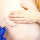 seno tuberoso o mammella tuberosa: tutto quello che devi sapere